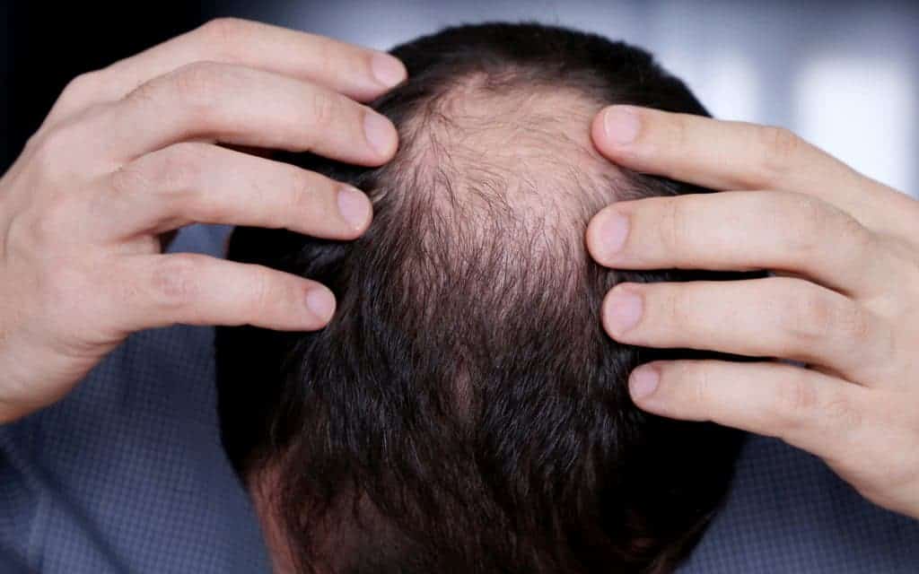 Hair Transplant in Jaipur