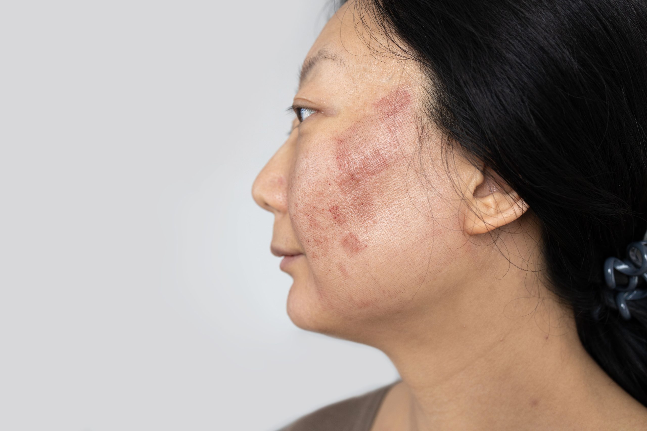 Burn Scar Treatment in Jaipur