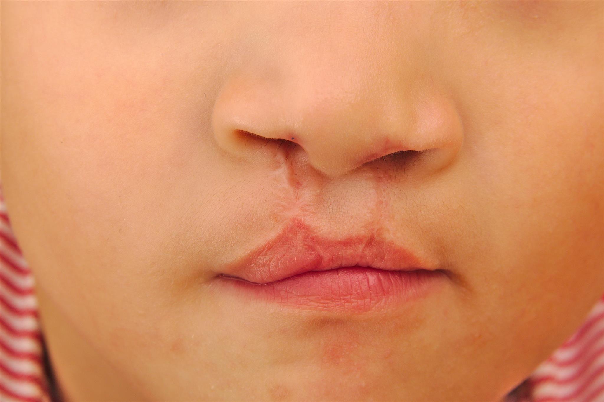 Cleft Lip and Palate Surgery in Jaipur