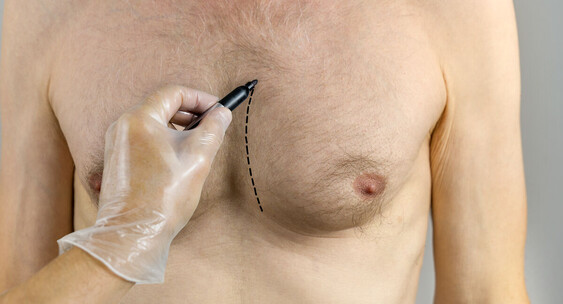 Gynecomastia Surgery in Jaipur