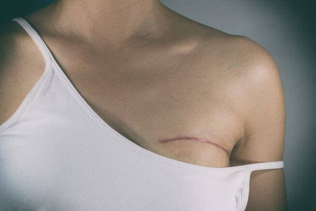 Breast Reconstruction Surgery in Jaipur