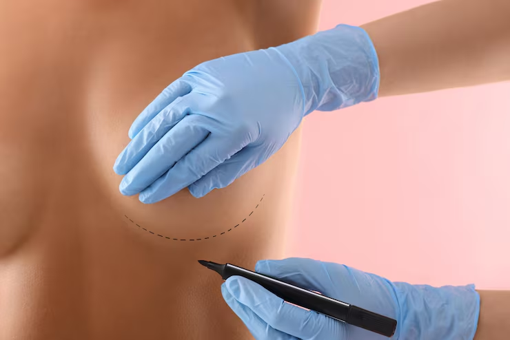 Breast Surgery in Jaipur
